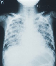 lung x-ray